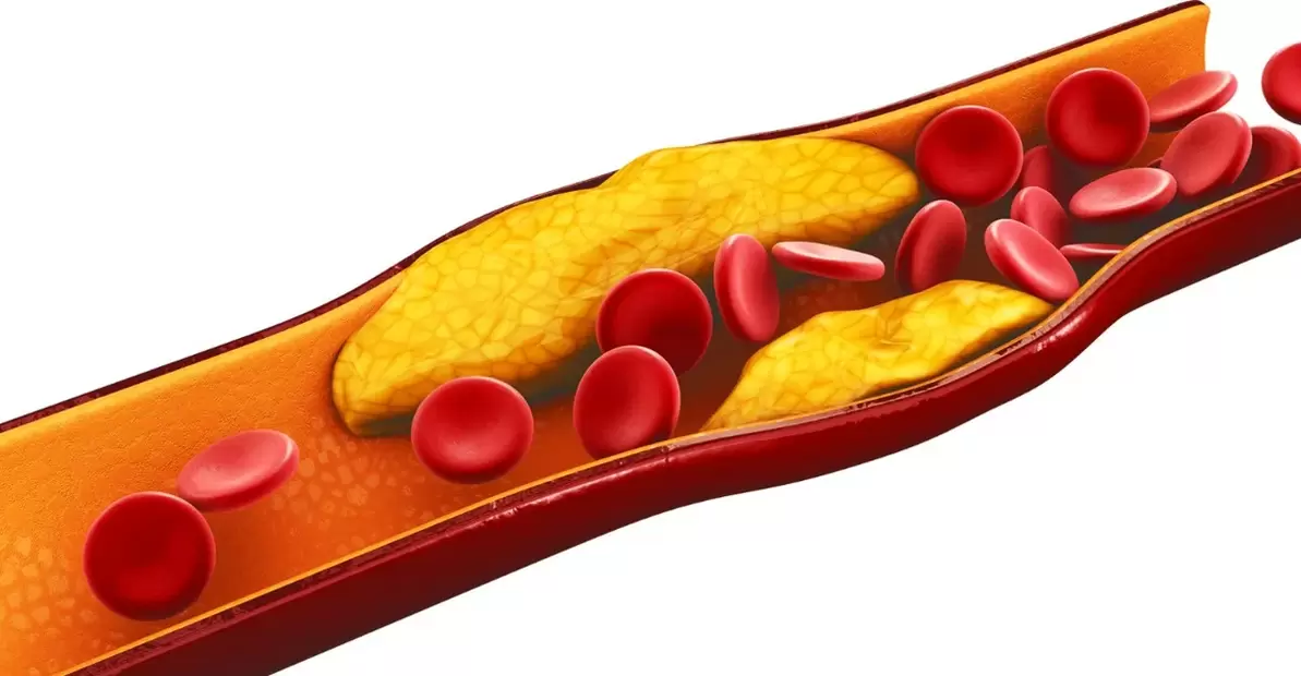 Der Grund für die Einnahme von MiCardium-Kapseln ist vaskuläre Arteriosklerose